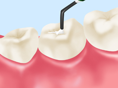 奥歯の虫歯を防ぐシーラント